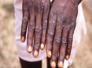 Affenpocken auf den Händen eines Infizierten in Afrika. - Foto: WHO
