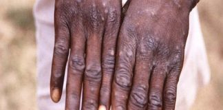 Zahl der Affenpocken-Fälle steigt weiter – Stiko empfiehlt Impfung für Risikogruppen – Impfstoff ab Mitte Juni